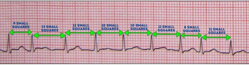 Electro CardioGraphy 